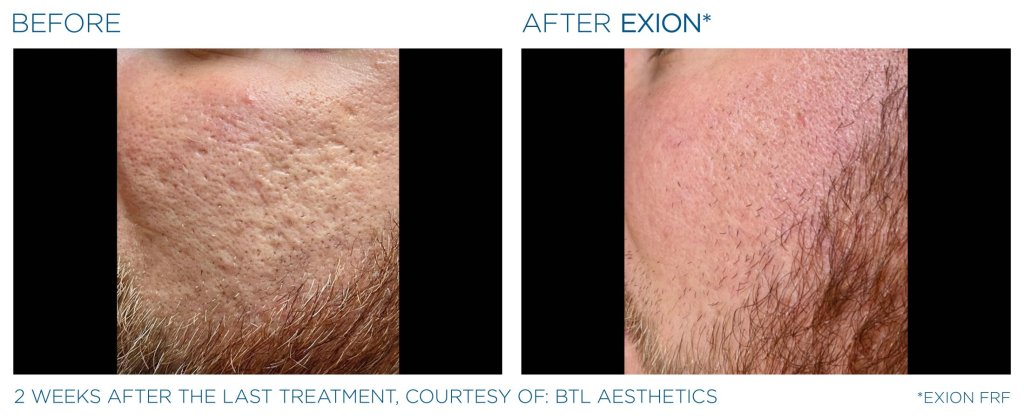 2 weeks after last treatment of Exion RF Microneedling